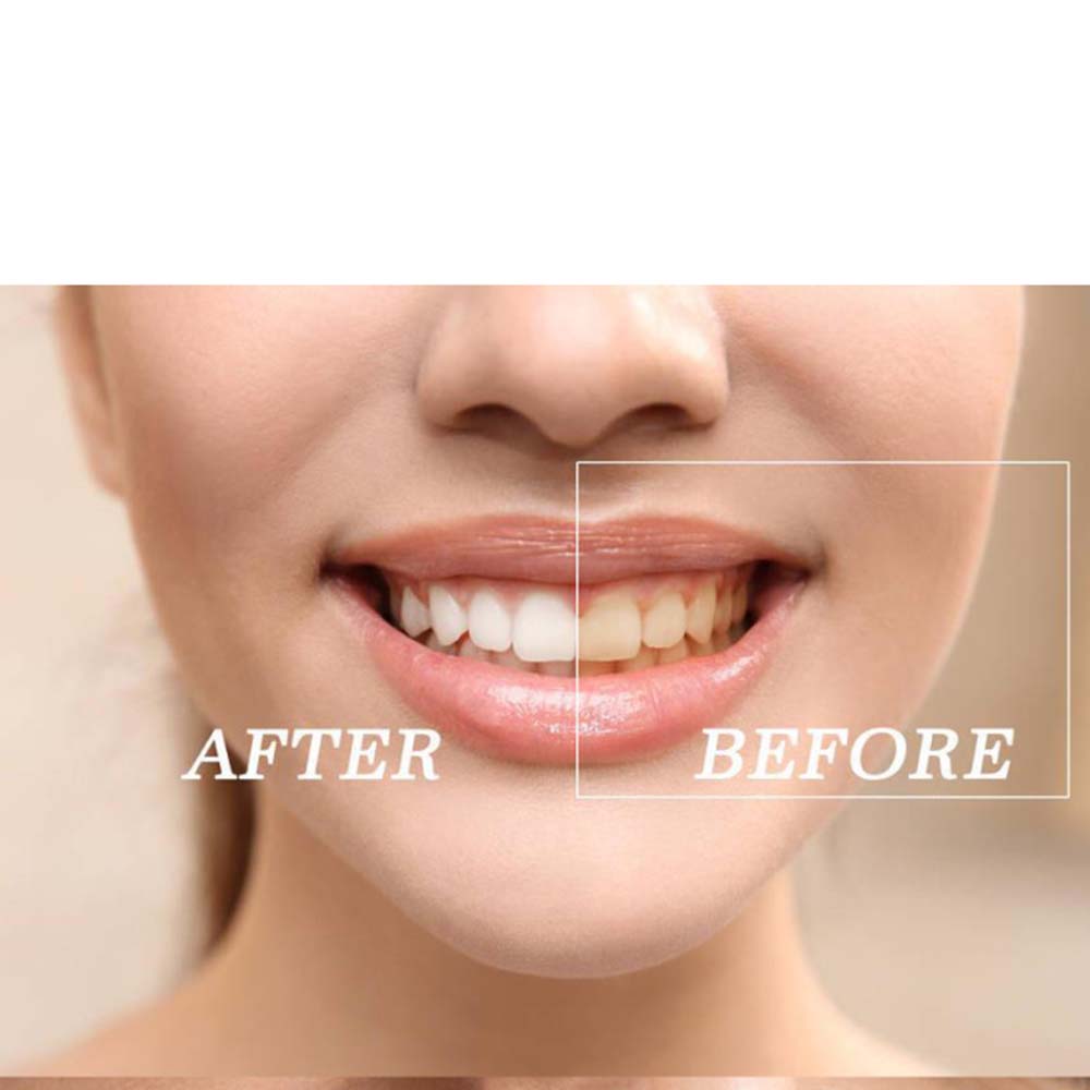 Top Quality Peroxide Teeth Whi - Teeth Whitening Kit 评论和价格