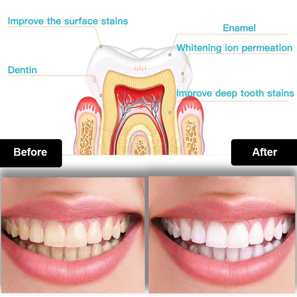 Dental Teeth Whitening Kit Min - Teeth Whitening Light Kit 评论和价格