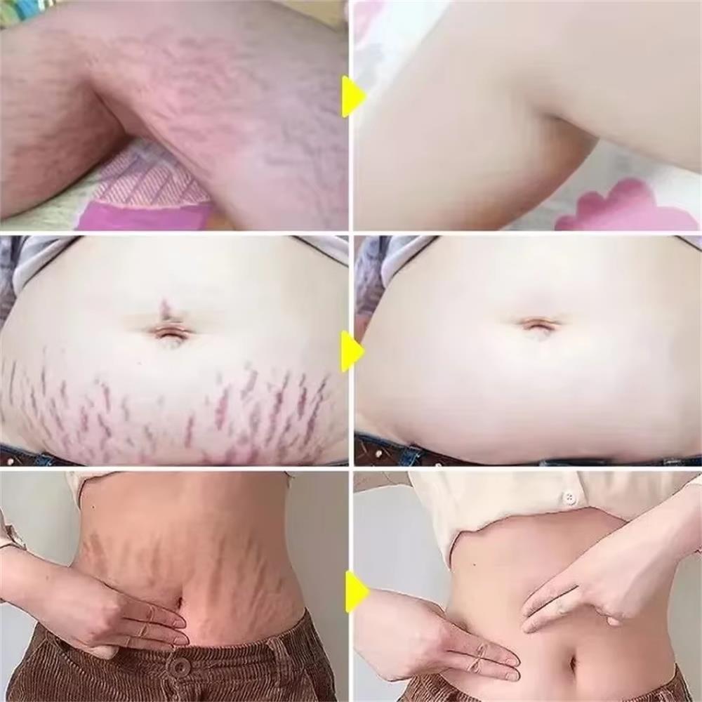 100g Stretch Marks Permanent R - Teeth Whitening Pregnancy 评论和价格