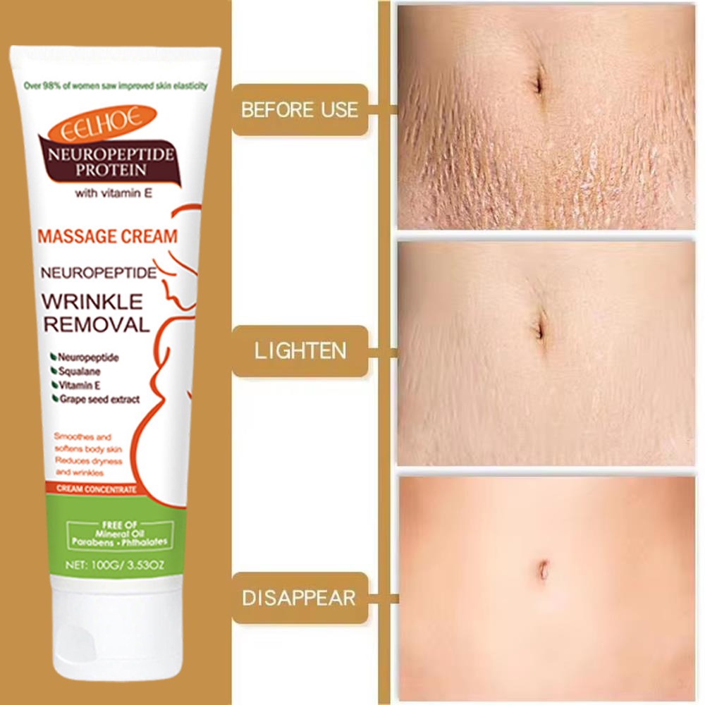 100g Stretch Marks Permanent R - Teeth Whitening Pregnancy 评论和价格